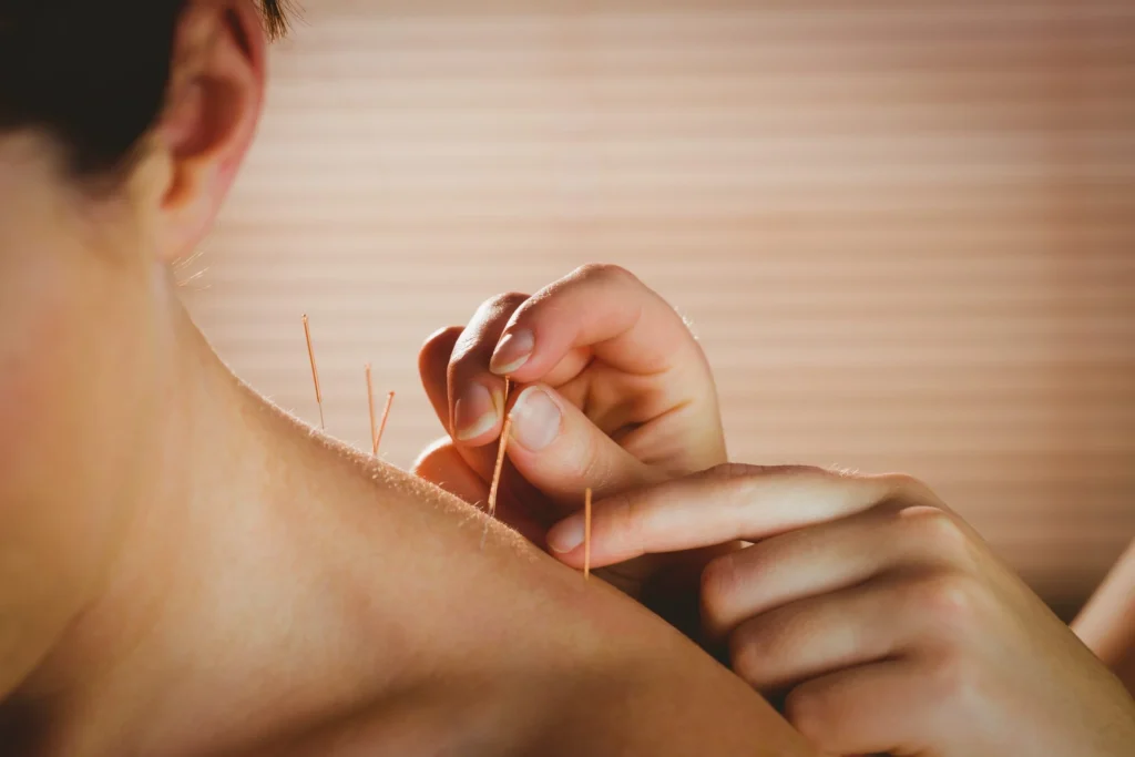 young-woman-getting-acupuncture-treatment-scaled
